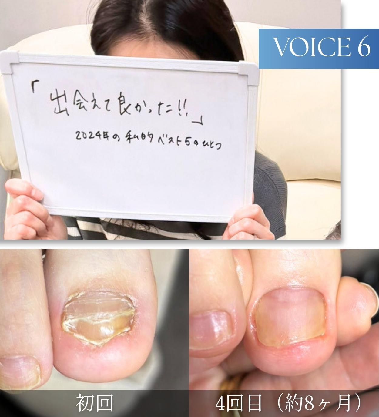 変形爪・段差で悩んでいたお客様の声6